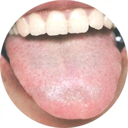 Comprehensive Guide to Tongue Diagnosis: A Must-Collect!