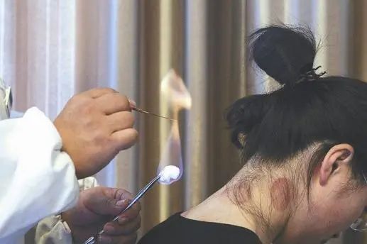 Acupuncture Department II: What Conditions Can Fire Needle Therapy Treat?