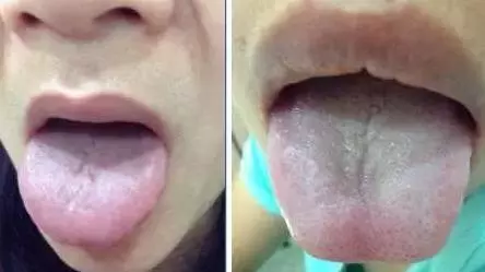 What Does Traditional Chinese Medicine Observe in the Tongue? Nine Body Types and Valuable Tongue Diagnosis Charts!