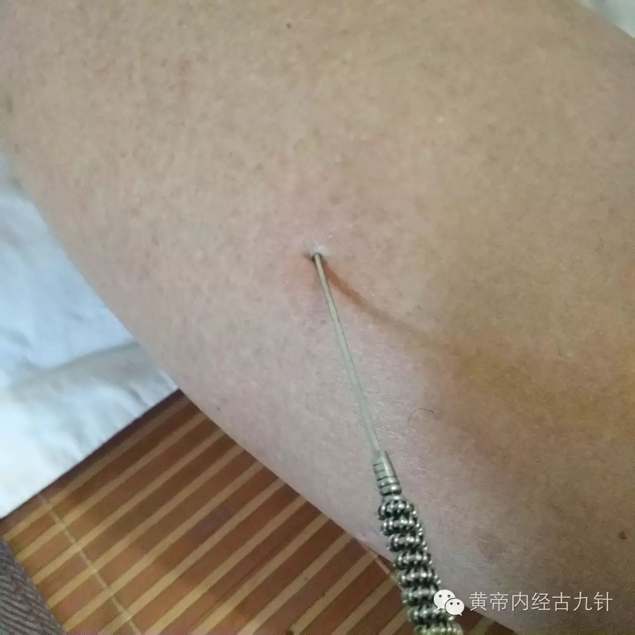 Discussion on the 'Mao Zhen' (Fine Needle) Technique