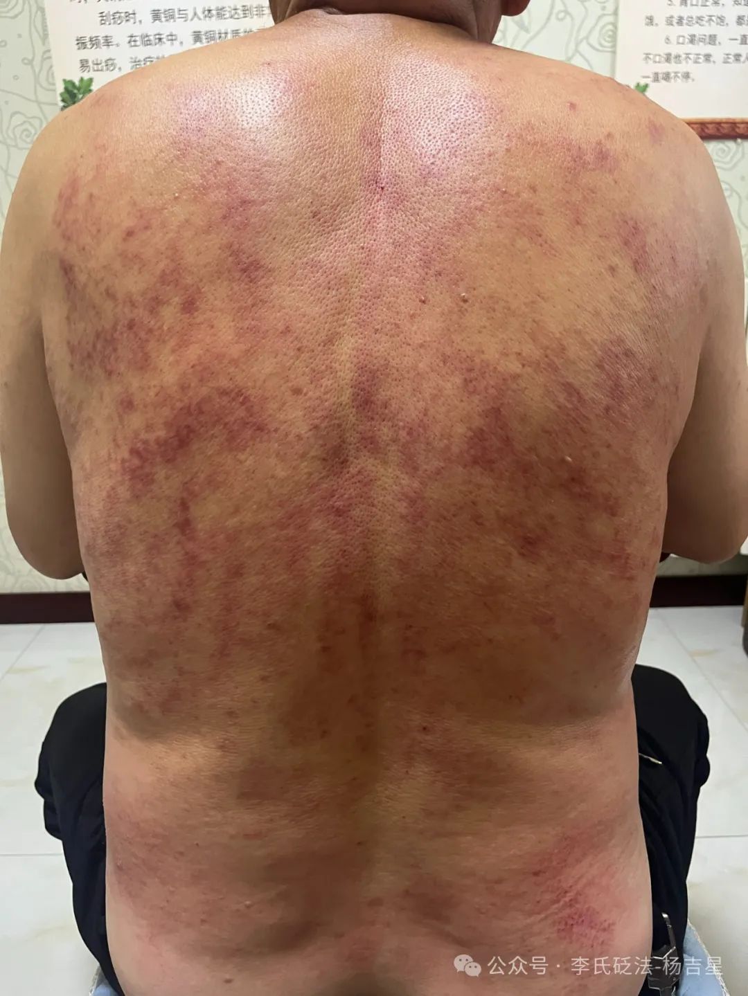 How to Use Gua Sha for Gout Management? Case Study (1)