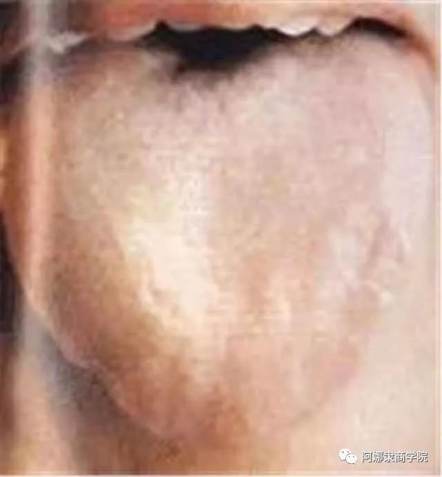 A Comprehensive Guide to 22 High-Definition Tongue Diagnosis Images: Understand Diseases Through Tongue Observation!