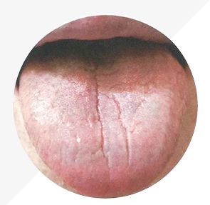 Understanding Tongue Diagnosis in TCM: Insights into Health from Tongue Appearance (Part 2)