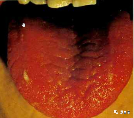 Basic Tongue Diagnosis - Tongue Body and Tongue Coating
