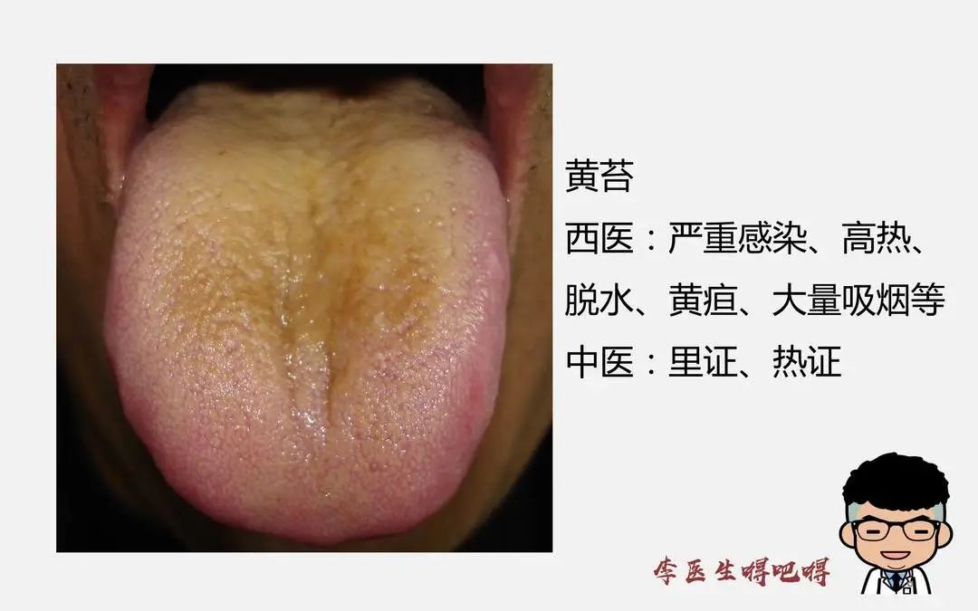 What Level of Tongue Diagnosis Does Western Medicine Have? Part 2: Tongue Quality and Coating