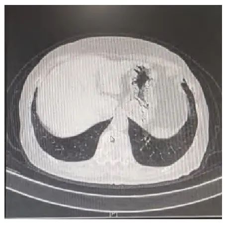 Professor Yan Guizhen's Experience in Treating Pulmonary Nodules Using the Principle of Supporting the Right and Expelling Pathogenic Factors