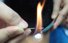 The Hidden Power of a Small Needle: The Miraculous Moxibustion Fire Needle Therapy