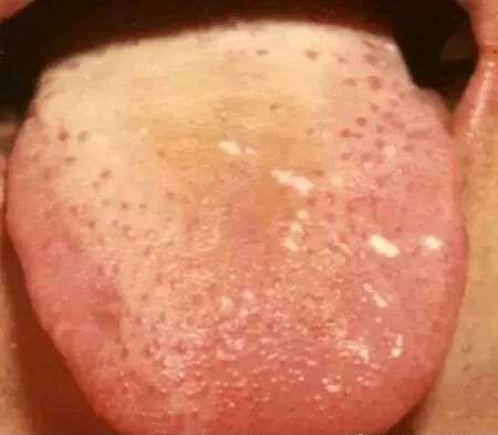 Tongue Diagnosis - Illustrated Guide to Tongue Manifestations