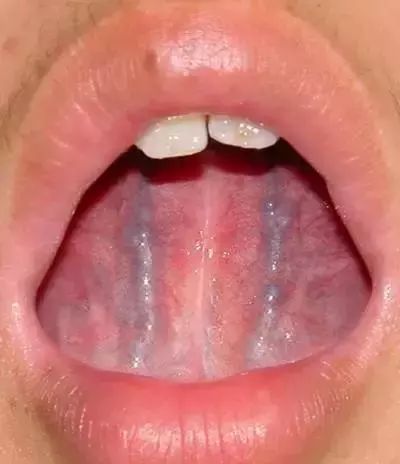 The Most Comprehensive Guide to Tongue Diagnosis! Master It and Become a Tongue Diagnosis Expert