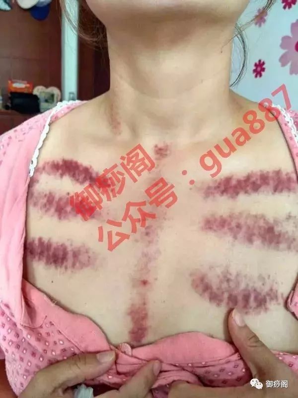 Why Gua Sha Should Not Be Limited to the Back: The Wonders of Gua Sha