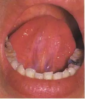 Understanding Disease Through Tongue Diagnosis in Traditional Chinese Medicine