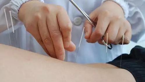 Acupuncture Techniques (A Must-Read for Acupuncturists)