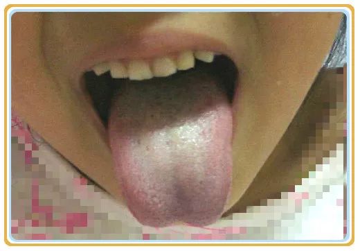 Analysis of Tongue Diagnosis: What to Do When the Tongue Coating is Thick and Slightly Yellow?