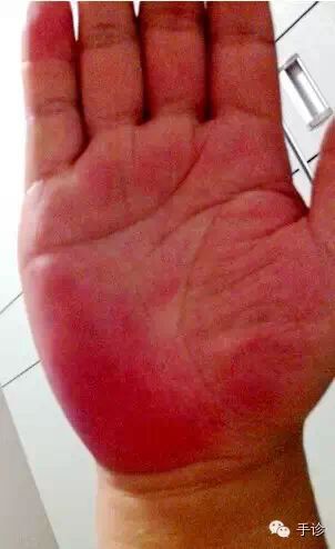 Eight Principles of Hand Diagnosis Based on Color Observation (Must-Collect)
