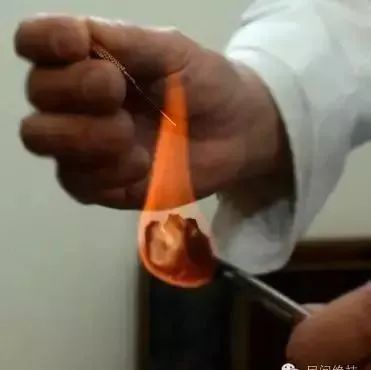 Fire Needle Therapy: Experience in Treating Seventeen Conditions, Practical Insights to Share!
