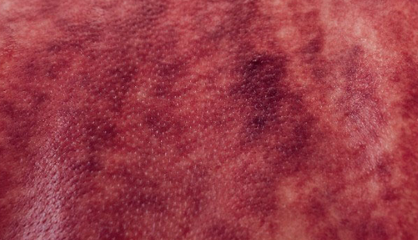Understanding the Signs of Gua Sha: Master These 5 Colors and 4 Shapes for Better Health