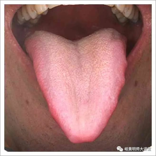 Traditional Chinese Medicine Tongue Diagnosis: Illustrated Guide to 14 Types of Tongue Shapes and Qualities