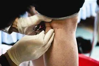 The Remarkable Bloodletting Therapy: A Solution for Various Diseases!