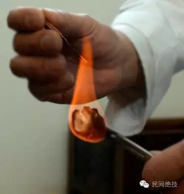 Experience Collection of Fire Needle Therapy