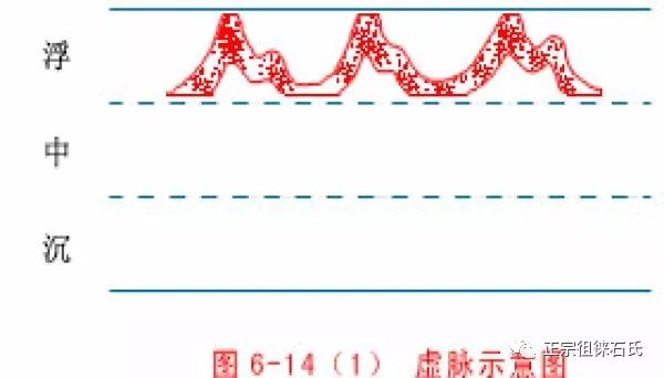 Pulse Diagnosis: Xu Mai (Deficient Pulse) and Shi Mai (Excess Pulse)