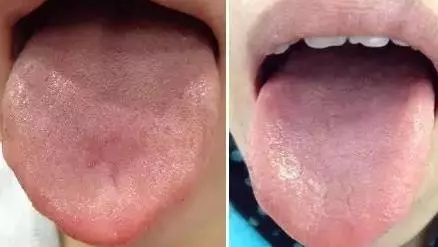 What Does Traditional Chinese Medicine Observe in the Tongue? Nine Body Types and Valuable Tongue Diagnosis Charts!