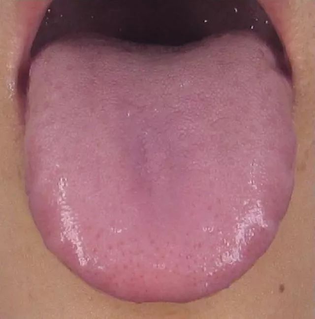 Understanding Health Through Tongue Diagnosis in Traditional Chinese Medicine