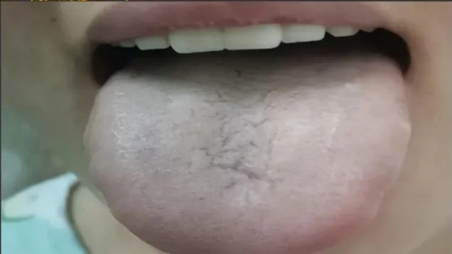 Traditional Chinese Medicine: Two Methods to Assess Blood Stasis and One Herbal Formula to Resolve It