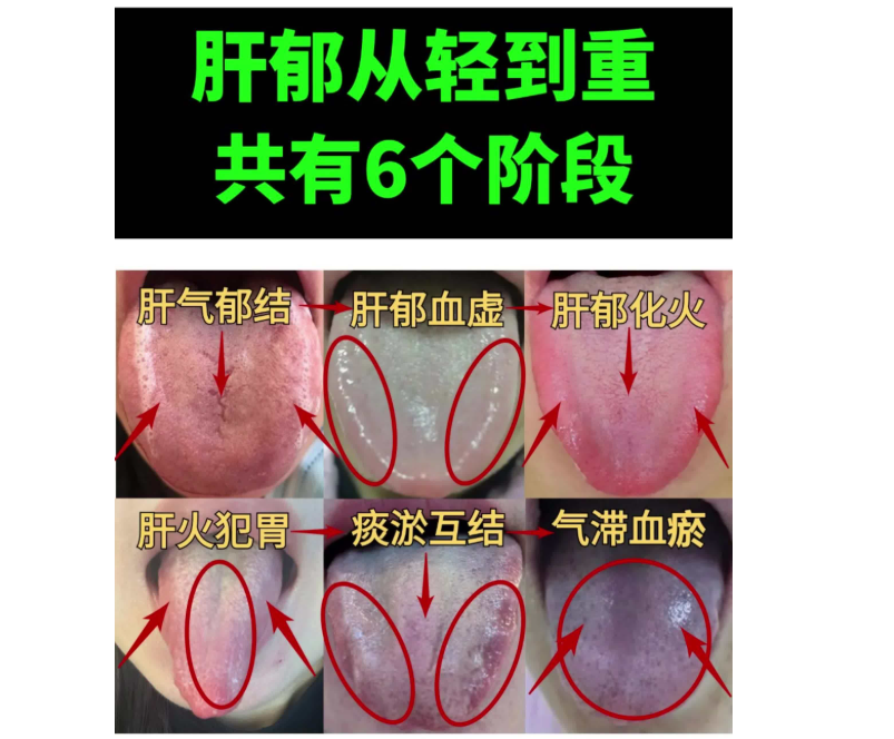 Liver Qi Stagnation Leads to Blood Stasis, Spleen Deficiency, and Heat Transformation! One Formula to Resolve Liver Qi Issues!