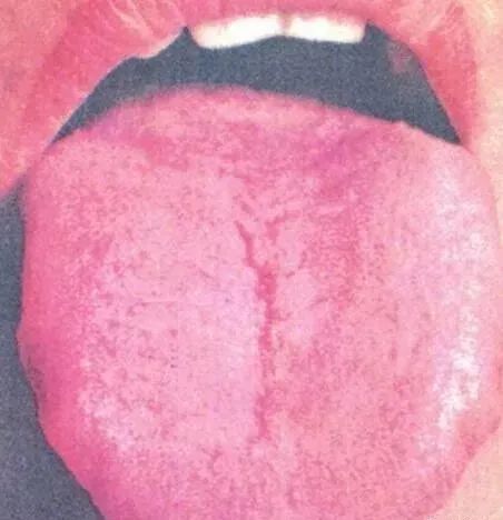 Comprehensive Guide to Tongue Diagnosis and Associated Conditions in TCM