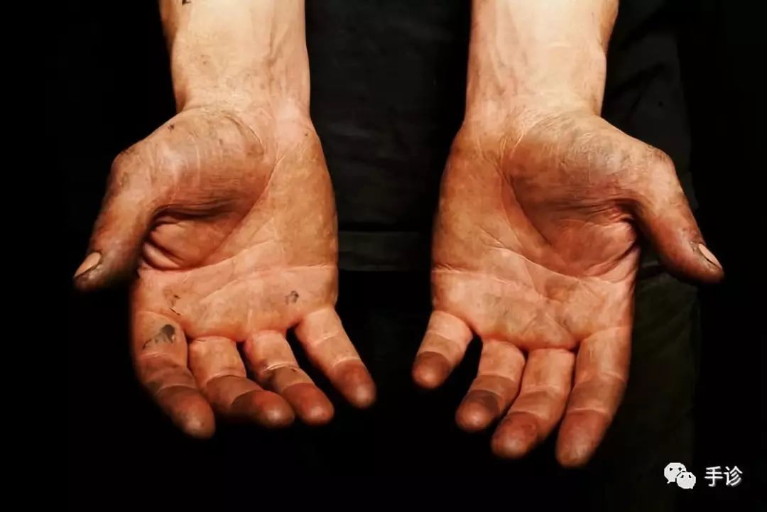 Eight Principles of Hand Diagnosis Based on Color Observation (Must-Collect)