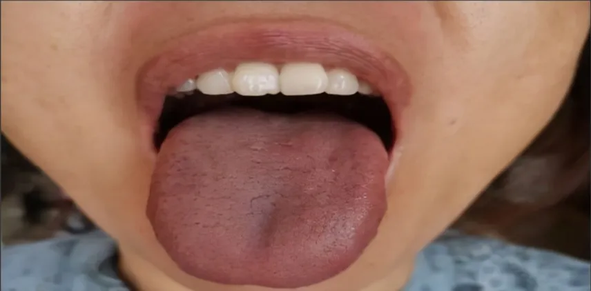 Traditional Chinese Medicine: Two Methods to Assess Blood Stasis and One Herbal Formula to Resolve It