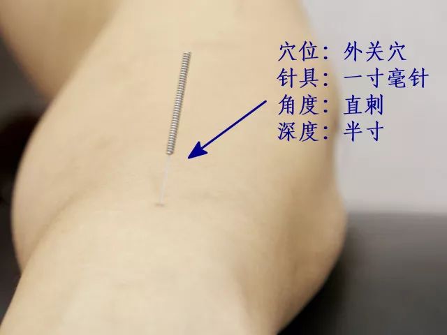Needles and Daily Acupuncture Practice Techniques