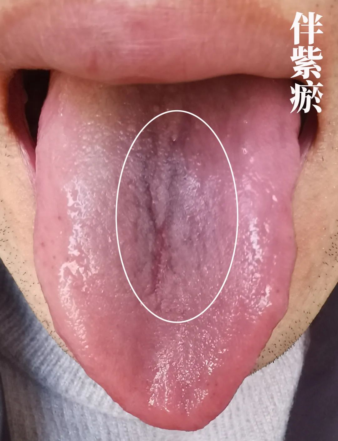 The Body Signals Illness: Understanding Tongue Diagnosis in TCM