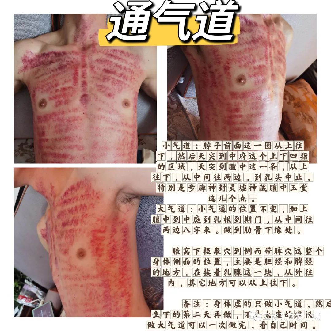 Summary of Common Diseases and Gua Sha Treatment Plans Including Human Reflex Maps, Contraindications, and Diagnosis of Sha Patterns