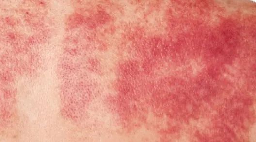 Understanding the Signs of Gua Sha: Master These 5 Colors and 4 Shapes for Better Health