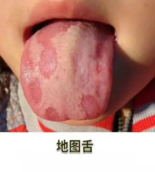 Tongue Coating Diagnosis in Traditional Chinese Medicine