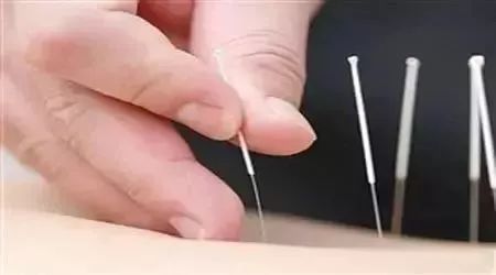 Five Essential Steps for Beginners in Acupuncture