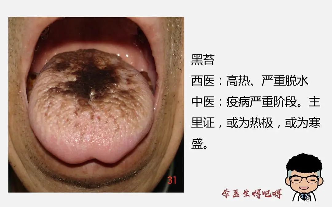 What Level of Tongue Diagnosis Does Western Medicine Have? Part 2: Tongue Quality and Coating