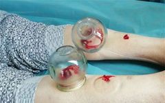 Treatment of Post-Stroke Sequelae with Bloodletting Therapy
