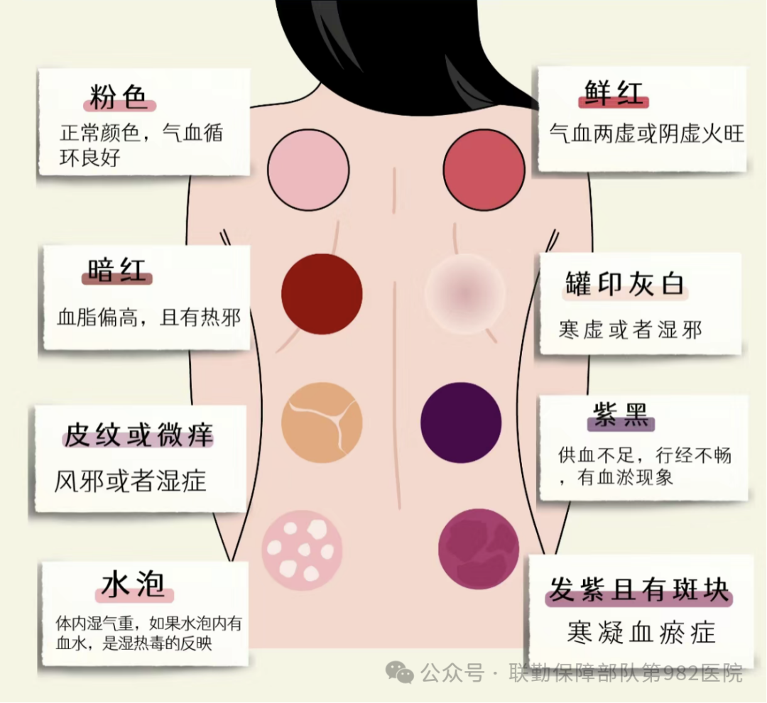 Traditional Chinese Medicine Therapy: 'Leopard Spot' Cupping Therapy