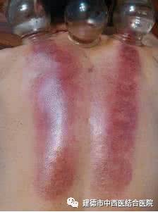 Cupping Therapy in Summer: An Effective Method to Eliminate Dampness, Relieve Heat, and Drive Away Cold