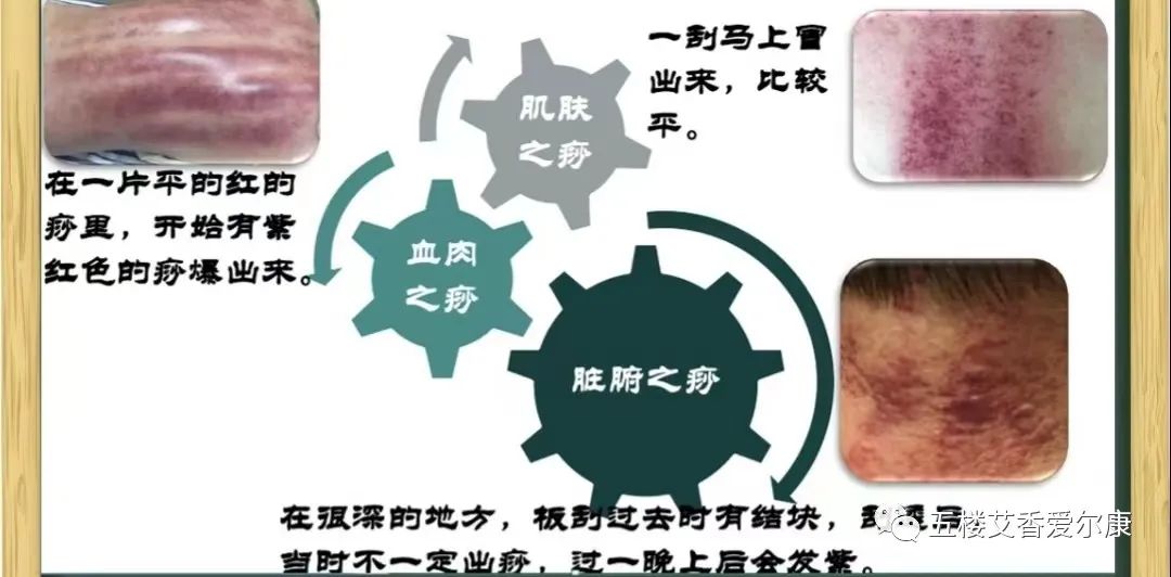 Summary of Common Diseases and Gua Sha Treatment Plans Including Human Reflex Maps, Contraindications, and Diagnosis of Sha Patterns