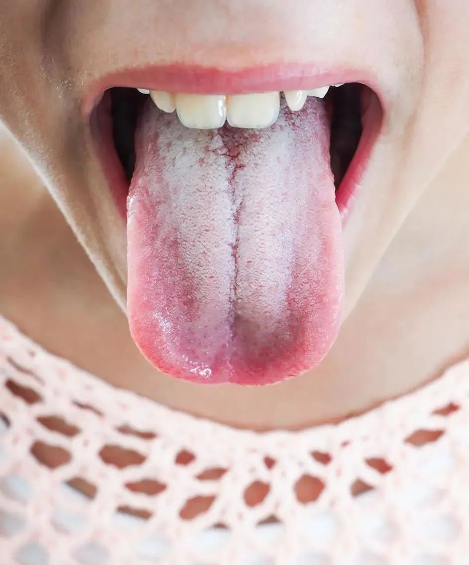 Traditional Chinese Medicine Tongue Diagnosis: What Different Tongue Appearances Indicate