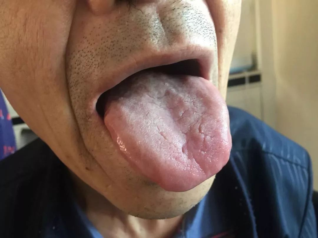 A Series on Tongue Diagnosis