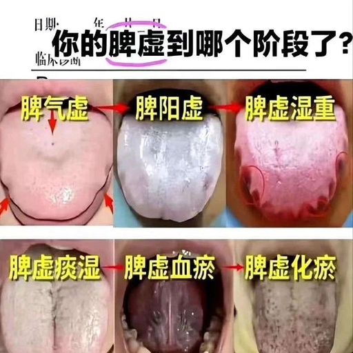 From Spleen Qi Deficiency to Blood Stasis: What Stage Does Your Tongue Indicate?