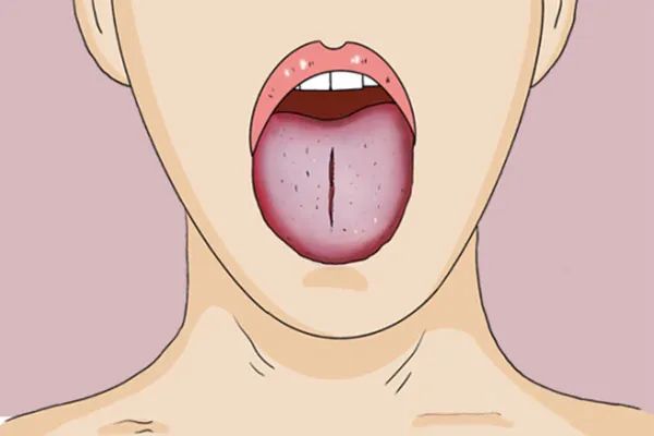 Observing the Tongue in Traditional Chinese Medicine: Tongue Color Changes Indicate Stroke!