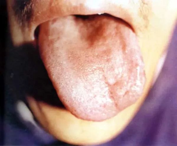 The Health Code Hidden on Your Tongue
