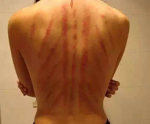 Understanding Gua Sha Symptoms and Their Implications