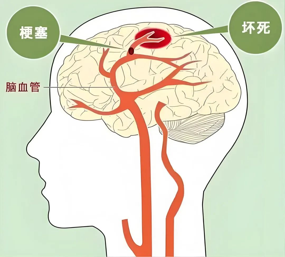 10 Treatment Plans for Cerebral Infarction: Effectively Activating Blood Circulation, Resolving Stasis, Nourishing Nerves, and Improving Sequelae