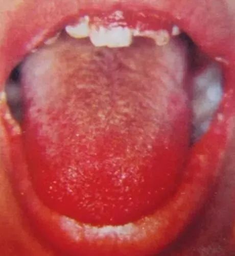 Comprehensive Guide to Tongue Diagnosis and Associated Conditions in TCM